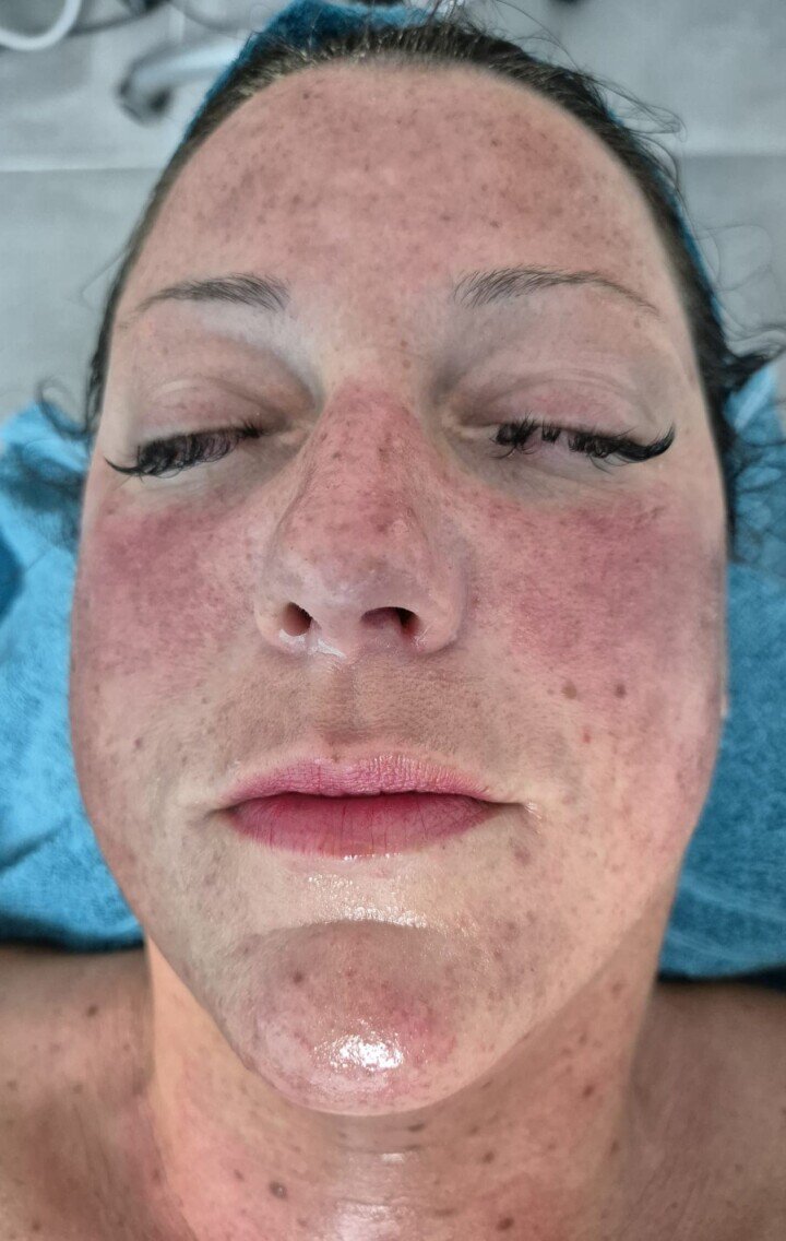 Haut mit Akne und Unreinheiten nach natürlicher Gesichtsbehandlung.