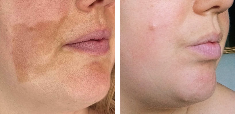 Hautverjüngung vor und nach der Behandlung mit Naturkosmetik.